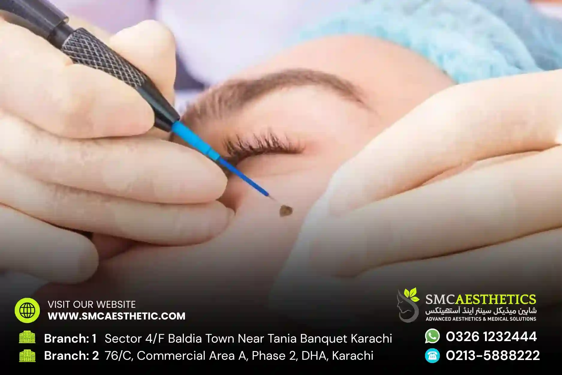 Moles and Warts Removal in Karachi - Clinical Excision at SMC Aesthetics
